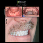 Gallery Mini Implant Supported Dentures Barnhart Dental