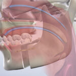 Sleep Apnea Winterholler Dental Implants Cosmetic Dentistry